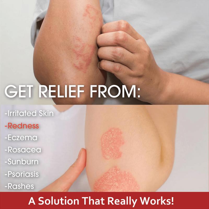 Herbal Skin Restore Sensitive Skin Relief Cream – Fast Relief from Eczema, Psoriasis, Blisters & Dry Itchy Skin with Oatmeal-Style Soothing, Zero-Irritant, Fragrance-Free – 30 g