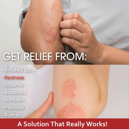 Herbal Skin Restore Sensitive Skin Relief Cream – Fast Relief from Eczema, Psoriasis, Blisters & Dry Itchy Skin with Oatmeal-Style Soothing, Zero-Irritant, Fragrance-Free – 30 g
